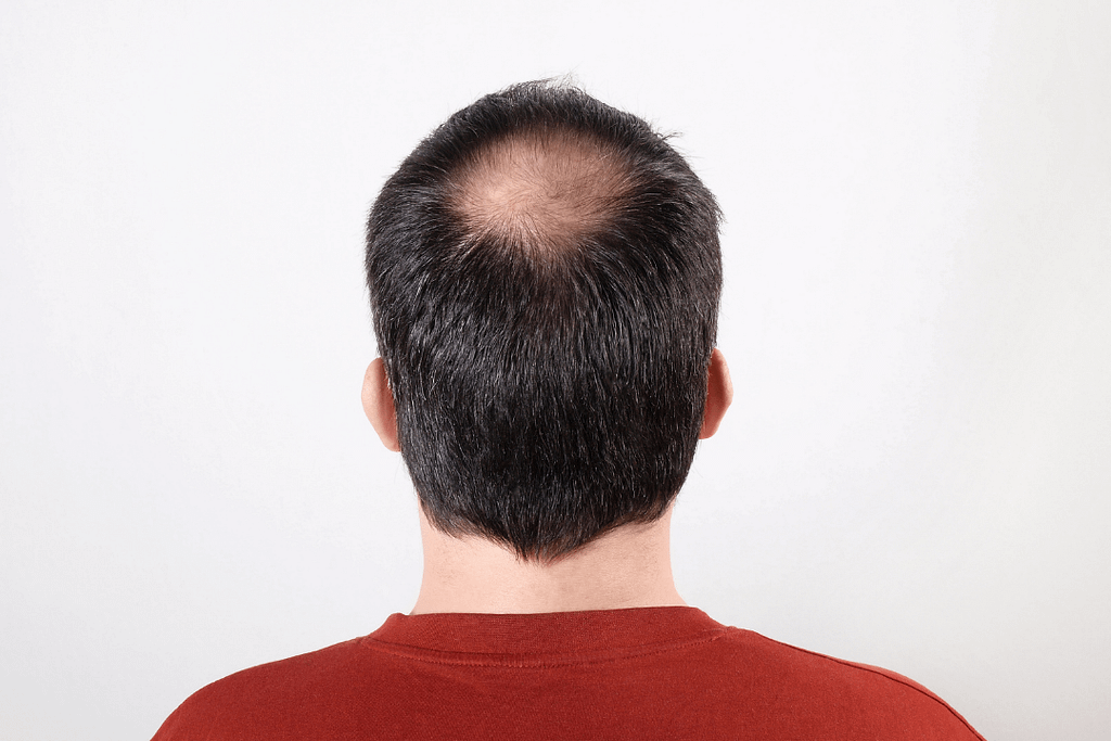 Pattern Hair Loss – UK Hair Consultants