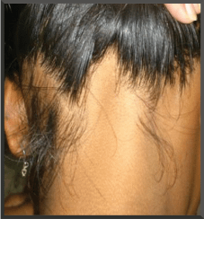 Alopecia Ophiasis