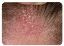 Seborrhoeic_Eczema