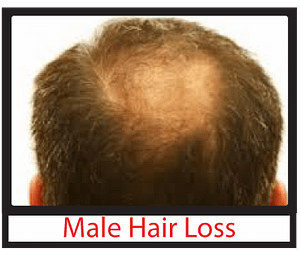 Male Hair loss