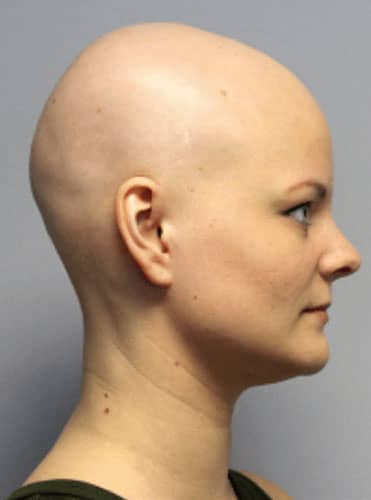 Alopecia - Hair Conditions
