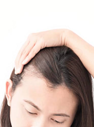 Alopecia - Hair Conditions
