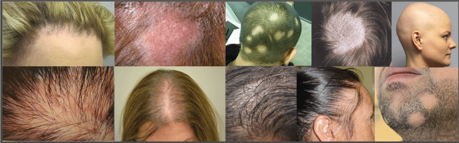 Alopecia – UK Hair Consultants